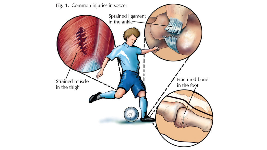 Major Injuries in Soccer: Causes, Prevention, and Road to Recovery
